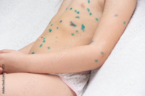 Child covered with green rashes the whole body ill with chickenpox, measles or rubella virus. Varicella. Infectious viral skin disease.Sick little girl with varicells making eruption on skin photo