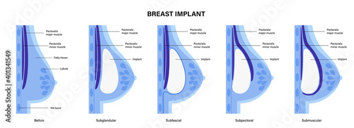 Breast Implant Concept