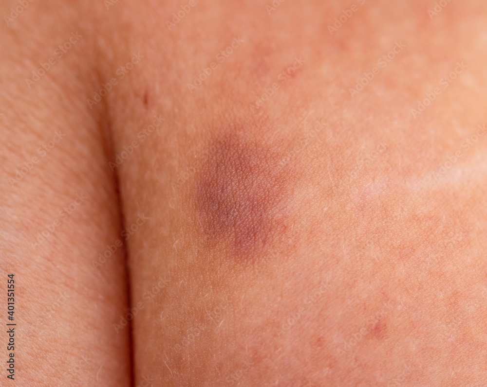 Fototapeta premium hematoma on the skin as a background