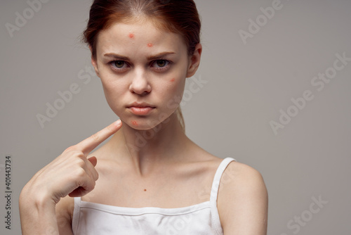 woman clean skin acne acne health problems dermatology