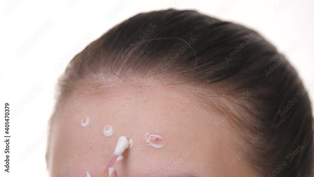 Hormonal pimples on the forehead. Teenage acne on young skin. Antirash