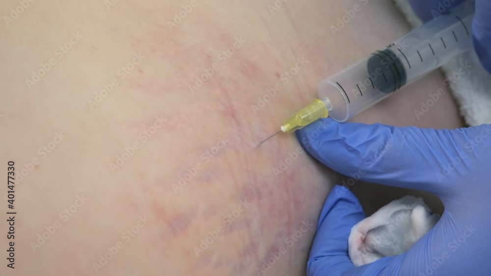 Doctor makes injection of ozone gas in patient woman on side of body on ...