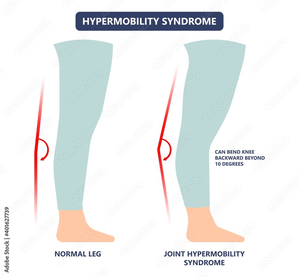 joint bend wrist knee leg pain Ehlers Danlos test elbow arm marfan jointed  body gene loose range of motion fragile tear flexible stretchy laxity  injury Stock Vector | Adobe Stock