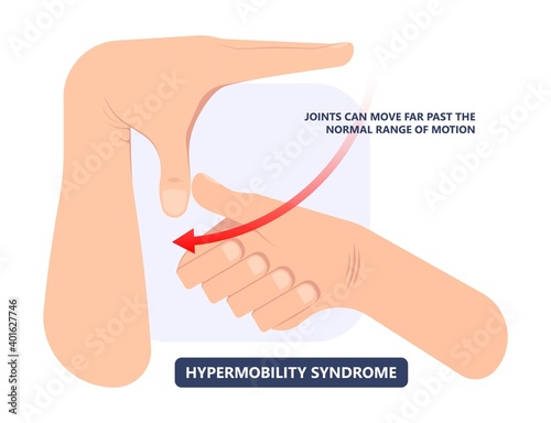 joint bend wrist knee leg pain Ehlers Danlos test elbow arm marfan jointed body gene loose range of motion fragile tear flexible stretchy laxity injury 
