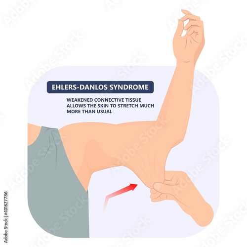 joint bend wrist knee leg pain Ehlers Danlos test elbow arm marfan jointed body gene loose range of motion fragile tear flexible stretchy laxity injury 