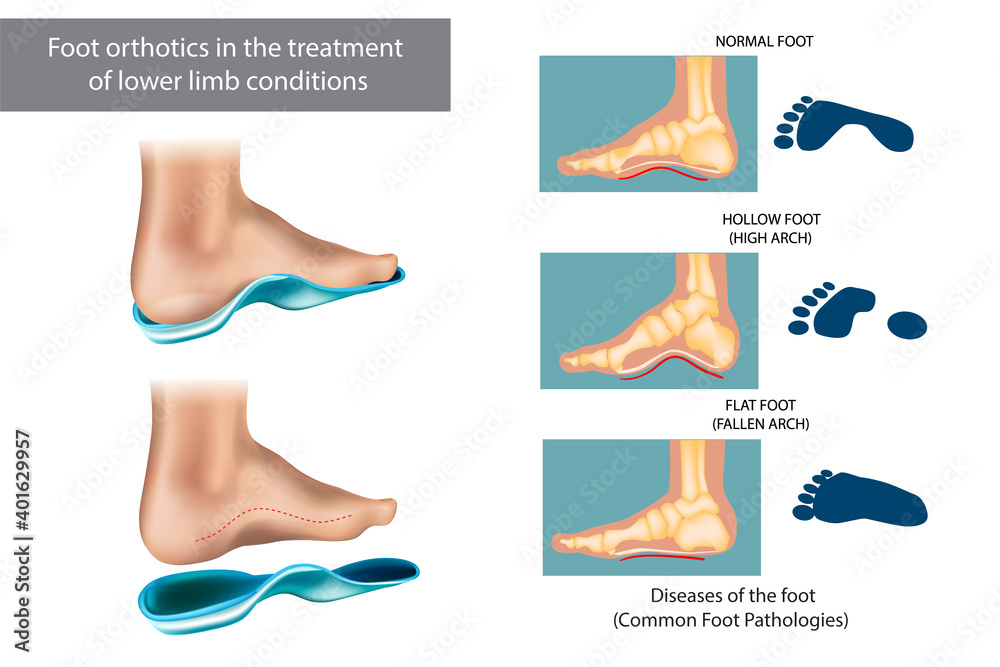 Diseases of the foot. Foot orthotics in the treatment of lower limb ...