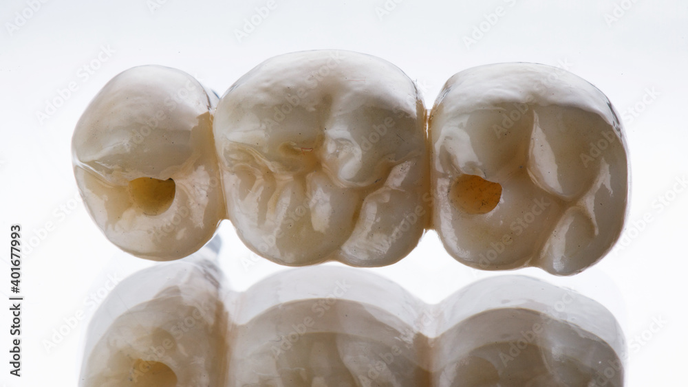 morphology of a dental bridge of three teeth on a white background