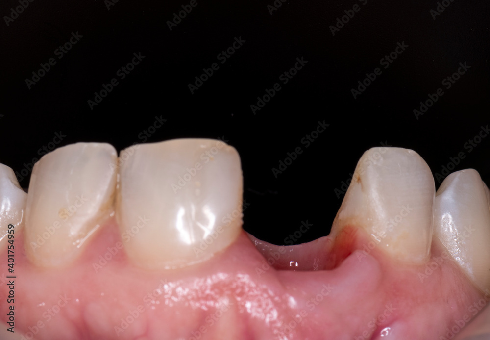 Fototapeta premium tooth no 11 press ceramic crown on implant