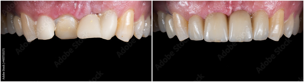 before and after picture for dental treatment by zirkon bridge