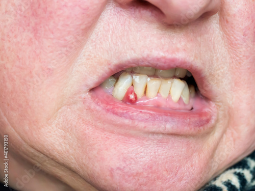 Φωτογραφία On the gum, an abscess formed, a tumor with purulent contents
