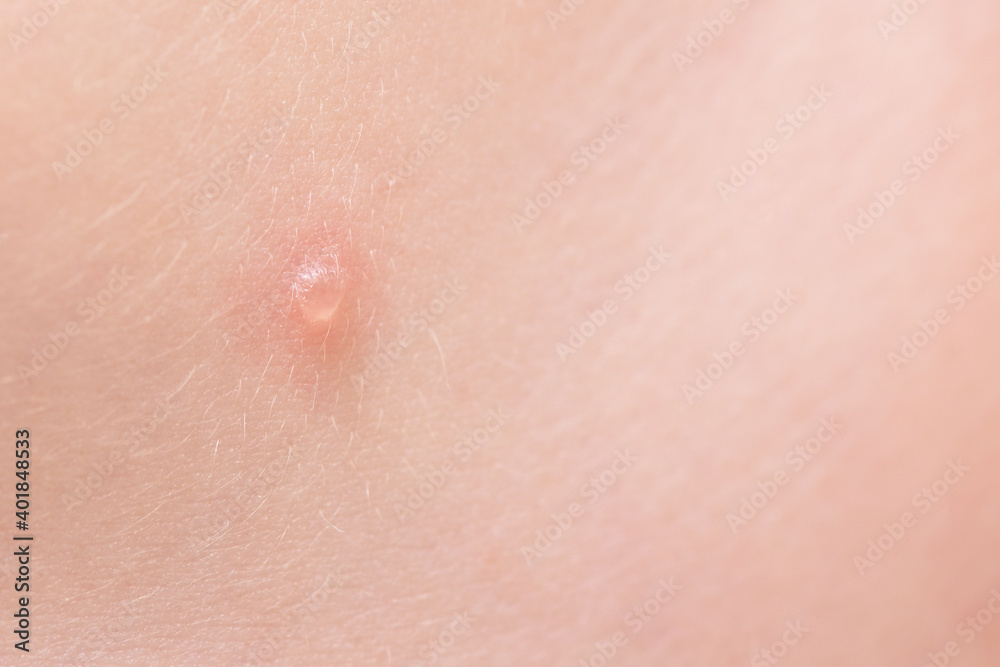 Close-up of a watery pimple on the skin from the disease chicken pox