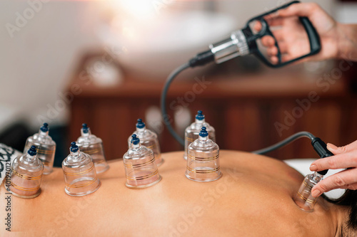 Cupping Therapy - Traditional Chinese Medicine photo