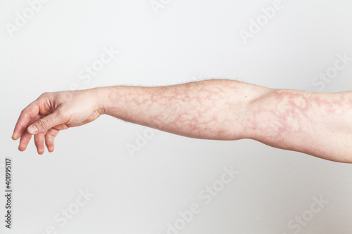 Male upright arm with red skin capillary network