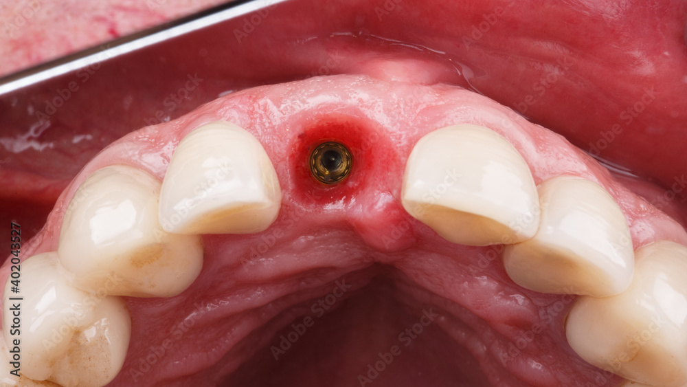 the gum cavity with the installed central incisor implant, view through the mirror