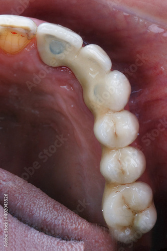 dental prosthesis for half the jaw in the patient's mouth