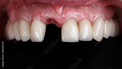 upper jaw without central incisor on a black background