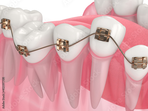 3d render of teeth alignment by orthodontic braces photo