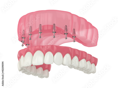 3d render of removable snap-on full implant denture installation