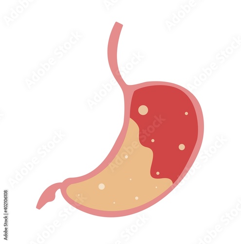 Flat illustration of abdominal bloating.