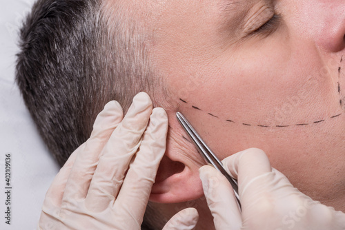 Foto Man beauty procedure beard hair implant for senior man