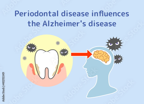 Relationship between periodontal disease and Alzheimer's disease