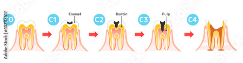 Caries and Progression and Treatment: Dental Illustration