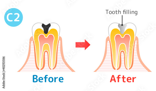 Caries and Progression and Treatment: Dental Illustration