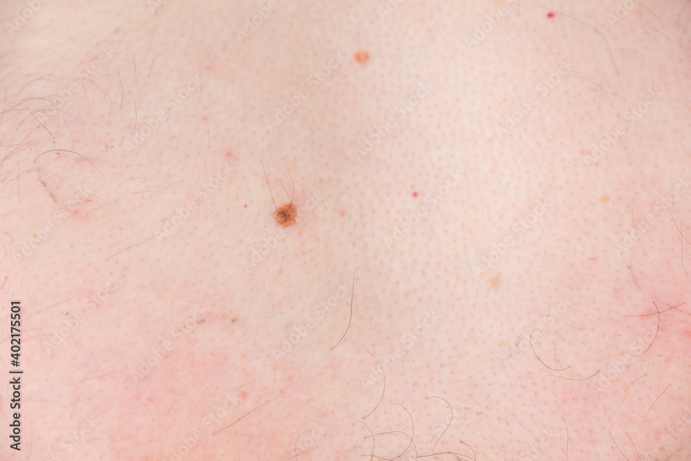 Mole, nevus on man's body before laser removing, closeup view. Man in clinic is preparing to laser removing of nevus, moles or papillomas.