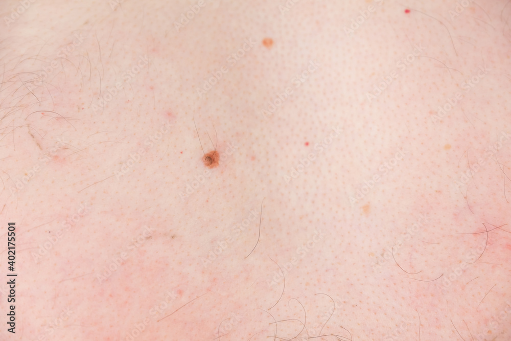 Fototapeta premium Mole, nevus on man's body before laser removing, closeup view. Man in clinic is preparing to laser removing of nevus, moles or papillomas.