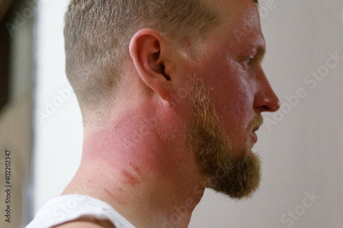 the face in the sun has burned so very red and painful