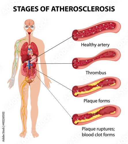 Stages of atherosclerosis information infographic photo