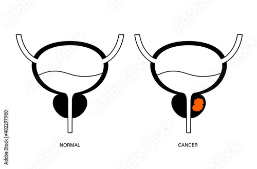 Prostate cancer concept