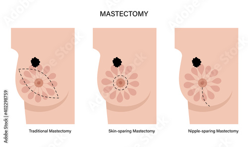 Breast disease concept