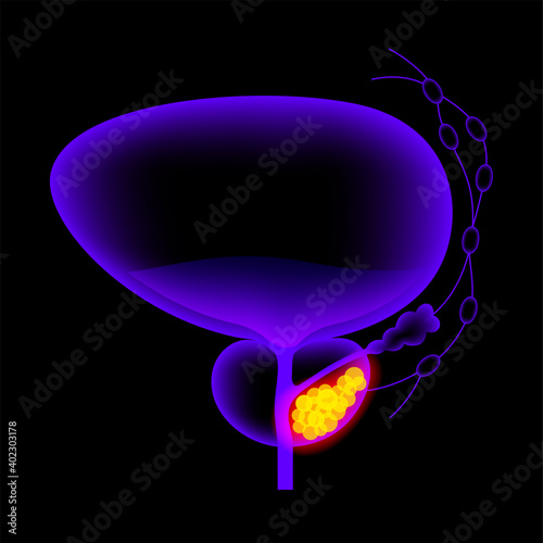 Prostate cancer concept