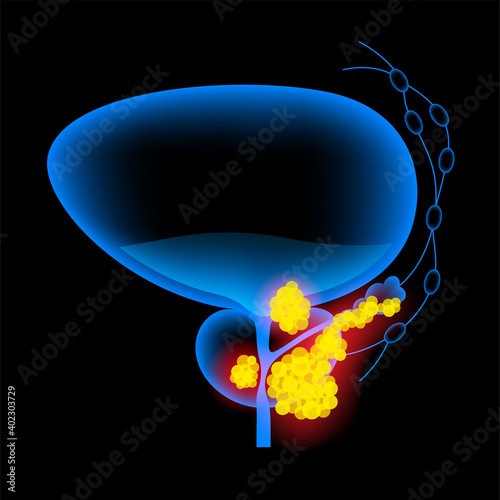 Prostate cancer concept