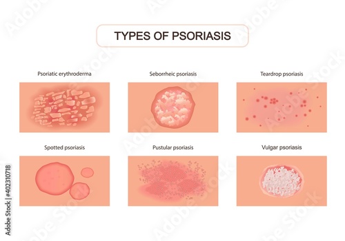 Varieties of psoriasis set. Red eruptions on skin with ulcers and itching damage upper layers of epidermis with allergies severe neurological disease with pustular abscesses. Pathological vector. photo