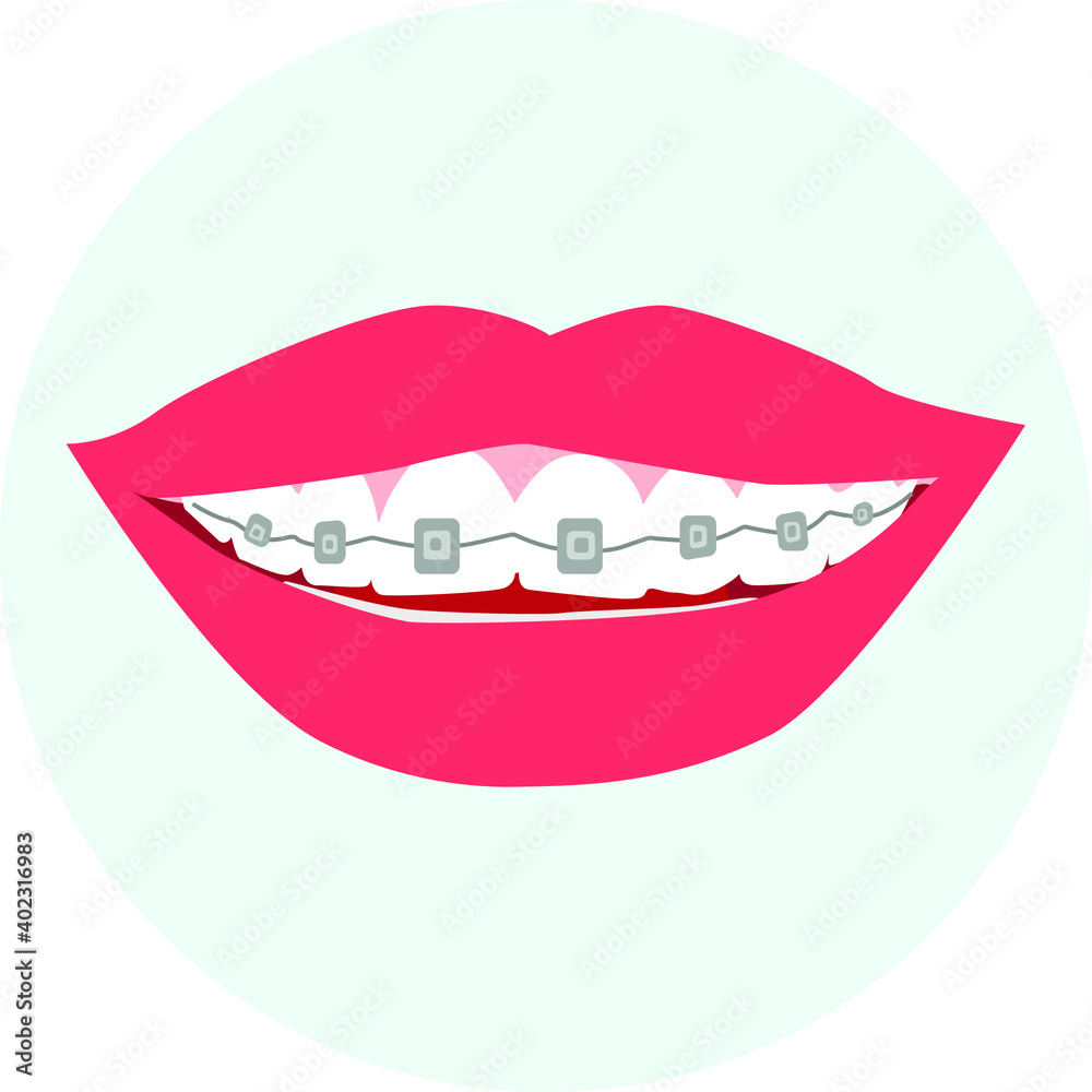 Beautiful smile in dental braces. Vector isolated Beautiful smile in dental braces. Vector isolated
