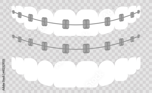 Vector illustration of the stages of orthodontic treatment braces on teeth . Teeth before and after braces on . Background in flat style