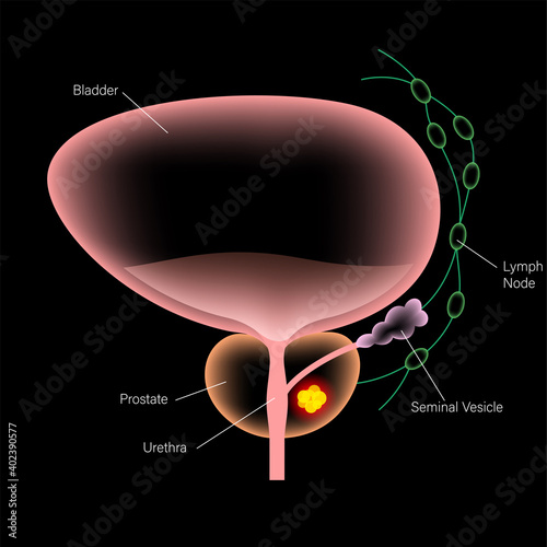 Prostate cancer concept