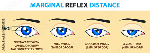 Marginal reflex distance. Vector illustration.