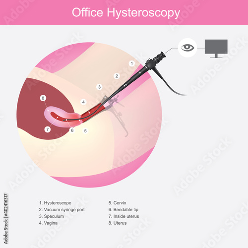 Office Hysteroscopy. Illustration showing the doctors use a micro camera (hysteroscope) insert passed a vagina into the uterus for diagnosis symptom..