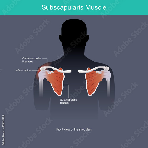 Subscapularis Muscle. Illustration for medical use explain the inflammation of muscle a shoulders in front view..