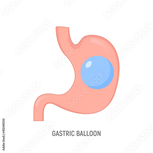 Gastric balloon weight loss intragastric surgery. Stomach gastric balloon operation vector icon