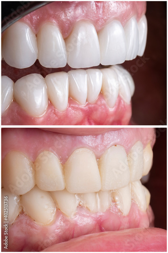 before and after picture after fixing 20 unit emax press ceramic veneers