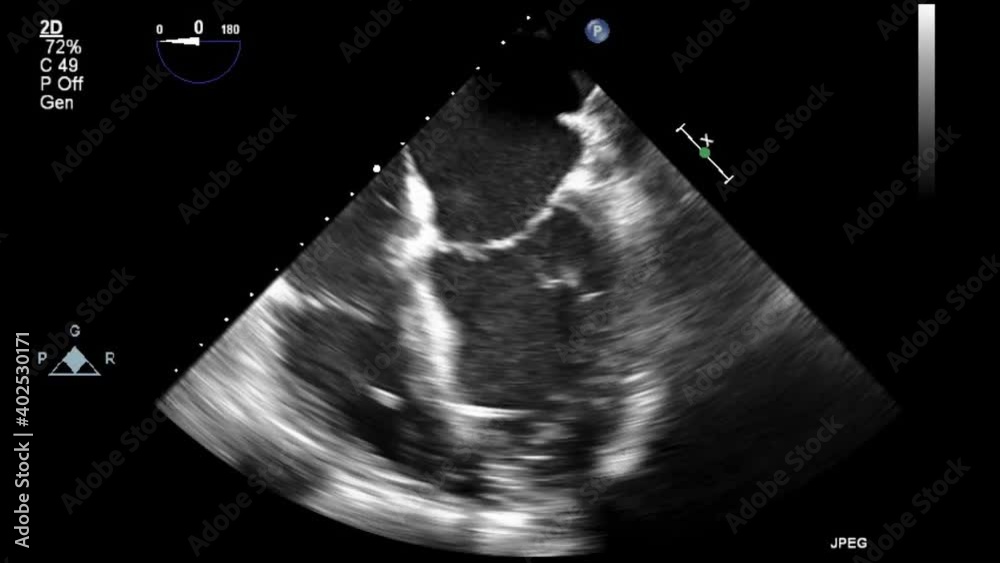 Transesophageal ultrasound video in gray-scale mode.