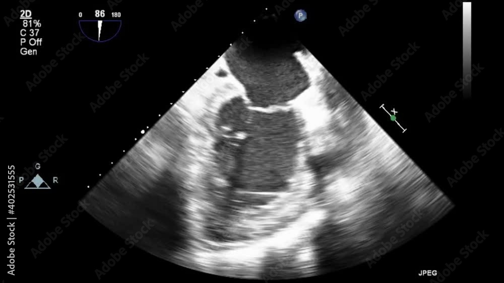 Transesophageal ultrasound video in gray-scale mode.