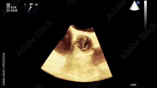 Transesophageal ultrasound video in 3D mode.