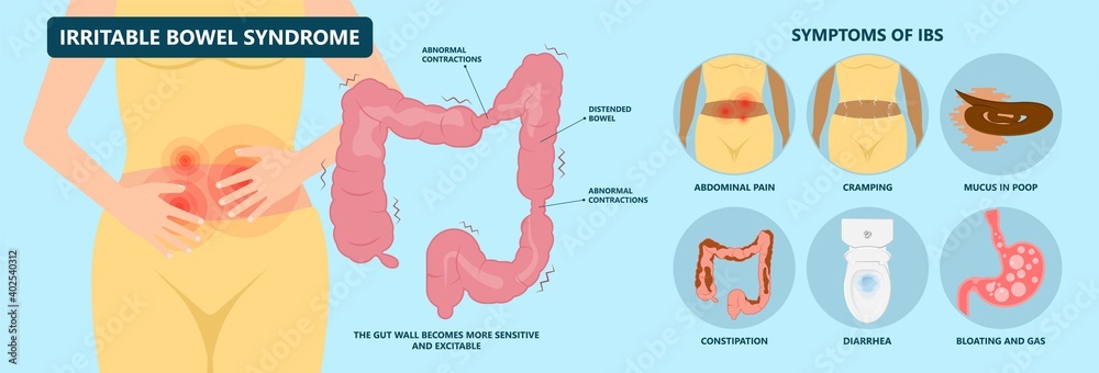 IBS large small pain gas treat cancer mucus stool colon Rectal tract virus  bacterial overgrowth IBD colitis Crohn's sibo diarrhoea belly celiac  gastritis blood Stock Vector | Adobe Stock