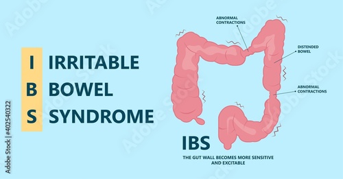 IBS large small pain gas treat cancer mucus stool colon Rectal tract virus bacterial overgrowth IBD colitis Crohn's sibo diarrhoea belly celiac gastritis blood
