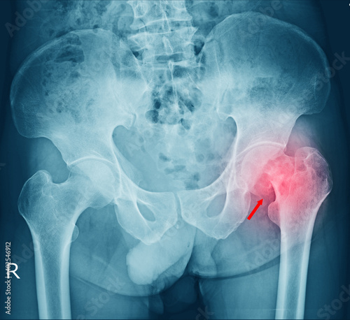 film x-ray a male pelvis fracture and arthritis at left hip joint